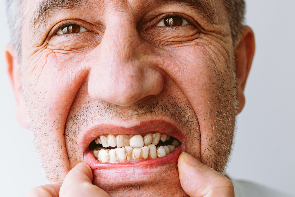 close up portrait of man showing teeth with tartar 2023 03 18 02 56 32 utc 1