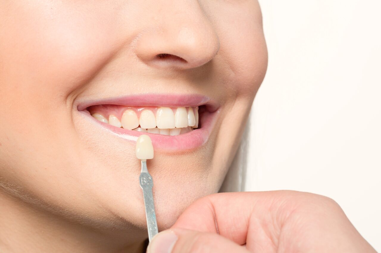 牙齒貼片網友們最關注的7個焦點！陶瓷貼片到底推不推薦？